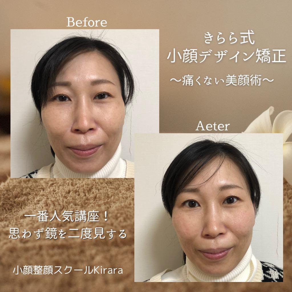無料相談会小顔